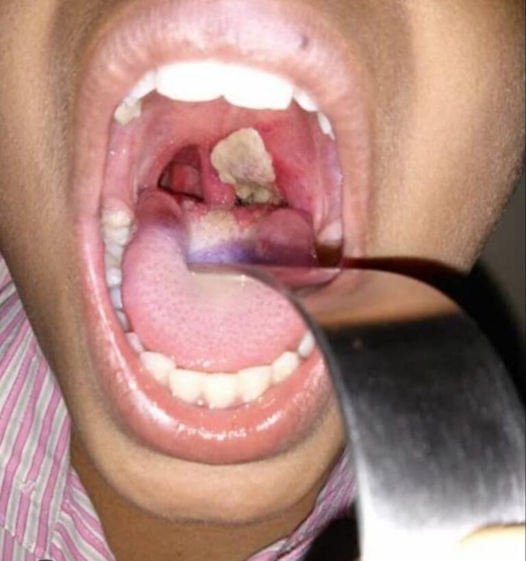 Diphtheria: Epidemiologist urges vigilance and prompt medical care in Gombe
